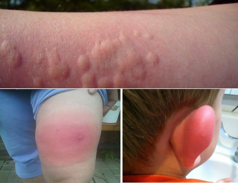 Аллергия на укус комара