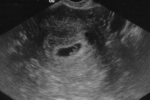 Эмбрион 5 недель на снимке УЗИ