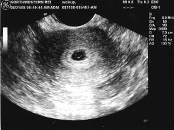 УЗИ на 6 неделе беременности