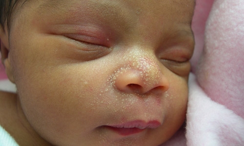 Белые точки на носу новорожденных