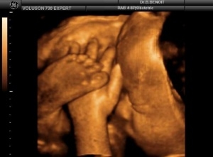Фото УЗИ на 41 неделе беременности