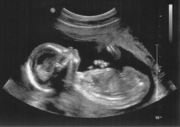 6 неделя беременности от зачатия фото