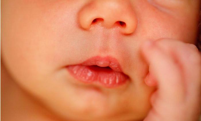 мозоль на губе у новорожденного 