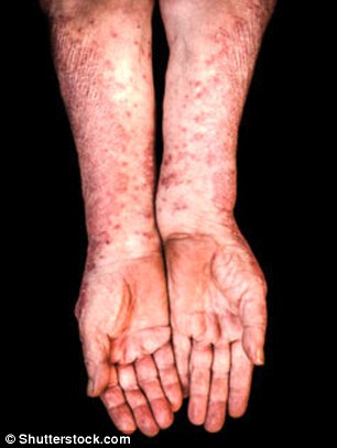 People with prosiasis (pictured) suffer often debilitating rashes made up of itchy, scaly plaques on their skin