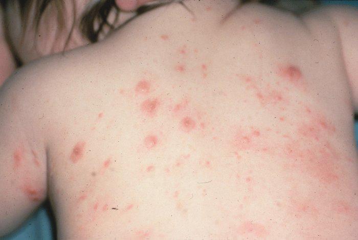 Аллергия на Манту