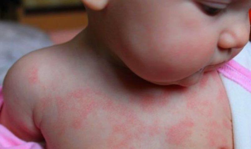 Проявление аллергии на лице и теле