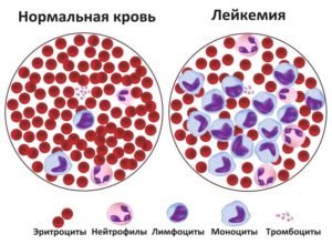 сравнение нормальной крови и лейкоза