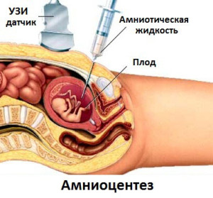 Амниоцентез