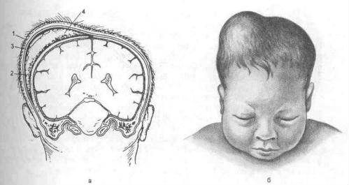 Кефалогематома у новорожденного - причина видимой деформации формы черепа